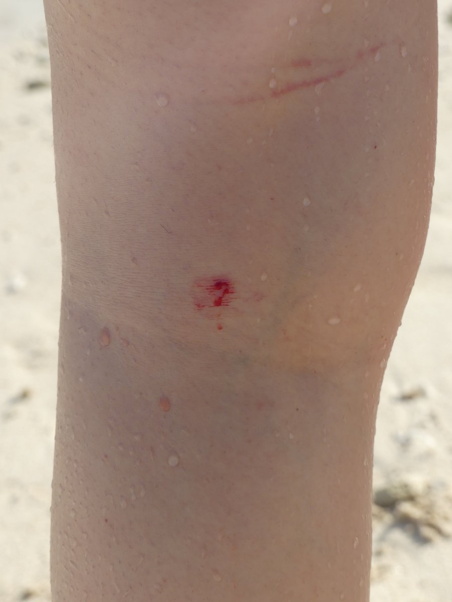 Close-up of the small but bleeding shark bite behind Line’s knee