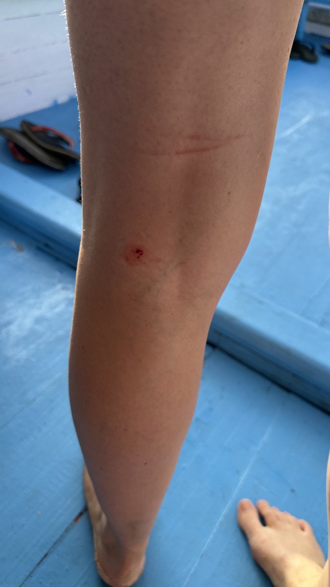 The shark bite and a scrape on Line’s leg, back on the boat deck
